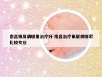 南昌银屑病哪里治疗好 南昌治疗银屑病哪家比较专业