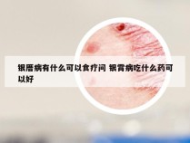 银厝病有什么可以食疗问 银霄病吃什么药可以好