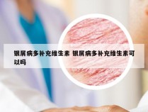 银屑病多补充维生素 银屑病多补充维生素可以吗