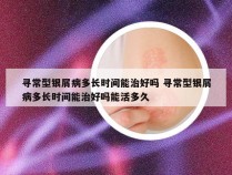 寻常型银屑病多长时间能治好吗 寻常型银屑病多长时间能治好吗能活多久