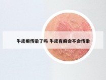 牛皮癣传染了吗 牛皮有癣会不会传染