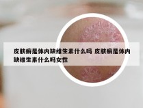 皮肤癣是体内缺维生素什么吗 皮肤癣是体内缺维生素什么吗女性