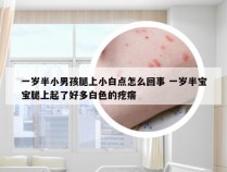 一岁半小男孩腿上小白点怎么回事 一岁半宝宝腿上起了好多白色的疙瘩