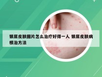 银屑皮肤图片怎么治疗好得一人 银屑皮肤病根治方法