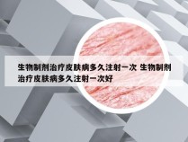 生物制剂治疗皮肤病多久注射一次 生物制剂治疗皮肤病多久注射一次好