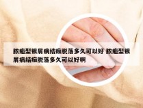 脓疱型银屑病结痂脱落多久可以好 脓疱型银屑病结痂脱落多久可以好啊