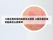 小腿总是反复的起癣怎么回事 小腿总是反复的起癣怎么回事啊