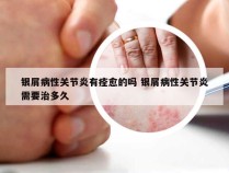 银屑病性关节炎有痊愈的吗 银屑病性关节炎需要治多久