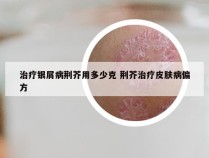 治疗银屑病荆芥用多少克 荆芥治疗皮肤病偏方