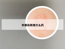 外那白斑用什么药