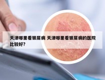 天津哪里看银屑病 天津哪里看银屑病的医院比较好?