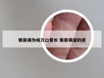 银屑病为啥刀口爱长 银屑病留的疤