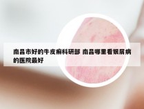 南昌市好的牛皮癣科研部 南昌哪里看银屑病的医院最好