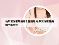 哈尔滨治银屑病哪个医院好 哈尔滨治银屑病哪个医院好