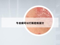 牛皮癣可以打新冠疫苗针