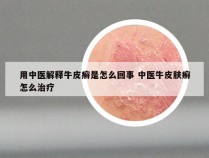 用中医解释牛皮癣是怎么回事 中医牛皮肤癣怎么治疗