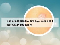 十四女生腿两侧有白点怎么办 14岁女腿上长好多红色条纹怎么办