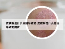 皮肤癣是什么原因导致的 皮肤癣是什么原因导致的图片