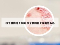 孩子胳膊腿上长癣 孩子胳膊腿上长癣怎么办