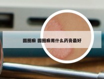 圆圈癣 圆圈癣用什么药膏最好