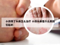 小孩得了头癣怎么治疗 小孩头癣是什么原因引起的