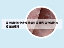 生物制剂对全身皮肤病有效果吗 生物制剂治疗皮肤瘙痒