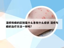 湿疹和癣的区别是什么各有什么症状 湿疹与癣的治疗方法一样吗?