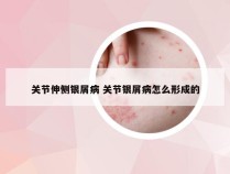 关节伸侧银屑病 关节银屑病怎么形成的