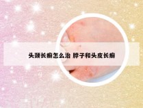 头颈长癣怎么治 脖子和头皮长癣