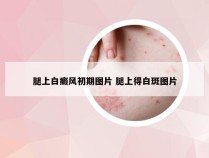 腿上白癜风初期图片 腿上得白斑图片