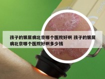 孩子的银屑病北京哪个医院好啊 孩子的银屑病北京哪个医院好啊多少钱