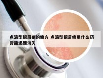 点滴型银屑病的偏方 点滴型银屑病用什么药膏能迅速消失