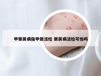 甲银屑病指甲做活检 银屑病活检可怕吗