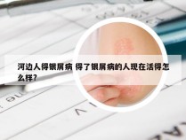 河边人得银屑病 得了银屑病的人现在活得怎么样?