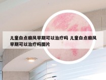 儿童白点癫风早期可以治疗吗 儿童白点癫风早期可以治疗吗图片