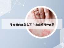 牛皮癣的血怎么写 牛皮血癣用什么药