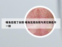 嘴角出现了白斑 嘴角出现白斑与其它颜色不一样