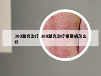 308激光治疗 308激光治疗银屑病怎么样