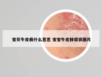 宝贝牛皮癣什么意思 宝宝牛皮鲜症状图片