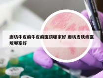 廊坊牛皮癣牛皮癣医院哪家好 廊坊皮肤病医院哪家好