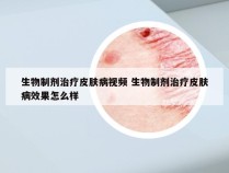 生物制剂治疗皮肤病视频 生物制剂治疗皮肤病效果怎么样