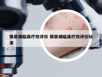 银屑病临床疗效评价 银屑病临床疗效评价标准