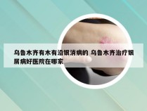 乌鲁木齐有木有沿银消病的 乌鲁木齐治疗银屑病好医院在哪家