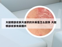 大腿根部皮肤大面积的长癣是怎么回事 大腿根部皮肤有藓图片