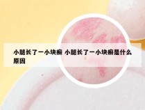 小腿长了一小块癣 小腿长了一小块癣是什么原因