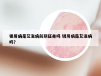 银屑病是艾滋病前期征兆吗 银屑病是艾滋病吗?