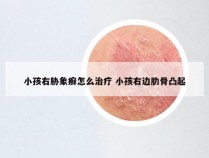 小孩右胁象癣怎么治疗 小孩右边肋骨凸起