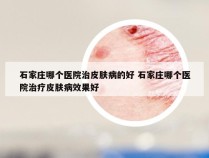 石家庄哪个医院治皮肤病的好 石家庄哪个医院治疗皮肤病效果好