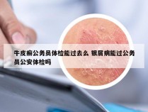 牛皮癣公务员体检能过去么 银屑病能过公务员公安体检吗