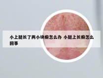 小上腿长了两小块癣怎么办 小腿上长癣怎么回事